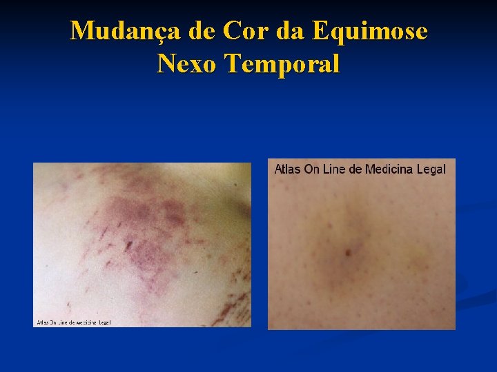 Mudança de Cor da Equimose Nexo Temporal 