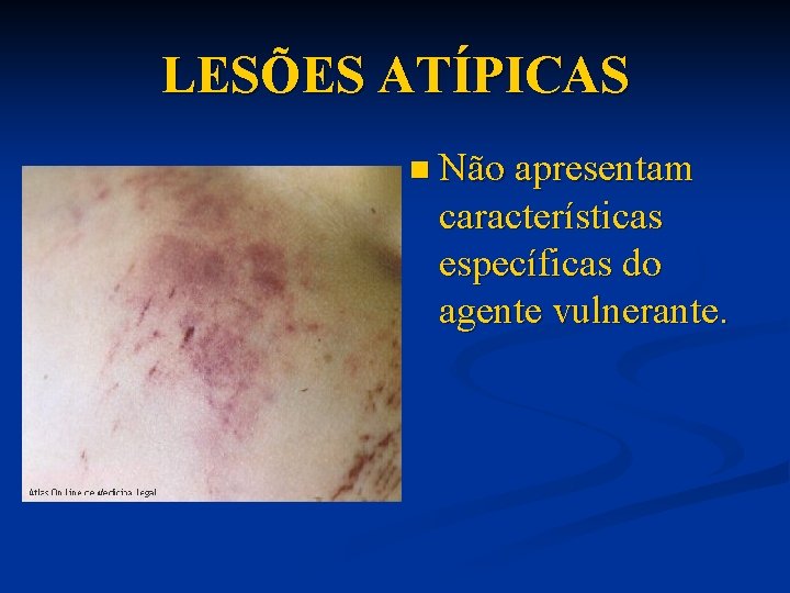 LESÕES ATÍPICAS n Não apresentam características específicas do agente vulnerante. 