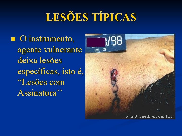 LESÕES TÍPICAS n O instrumento, agente vulnerante deixa lesões específicas, isto é, “Lesões com
