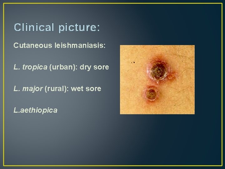 Clinical picture: Cutaneous leishmaniasis: L. tropica (urban): dry sore L. major (rural): wet sore