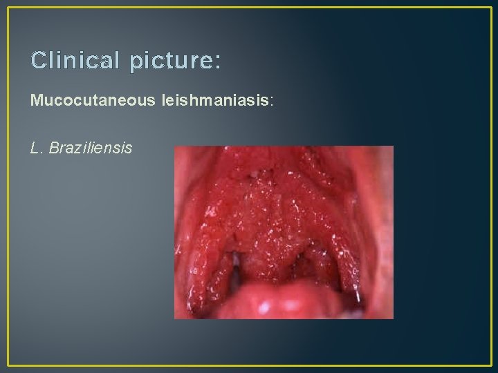 Clinical picture: Mucocutaneous leishmaniasis: L. Braziliensis 