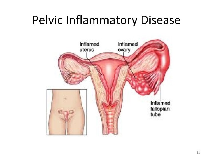 Pelvic Inflammatory Disease 11 