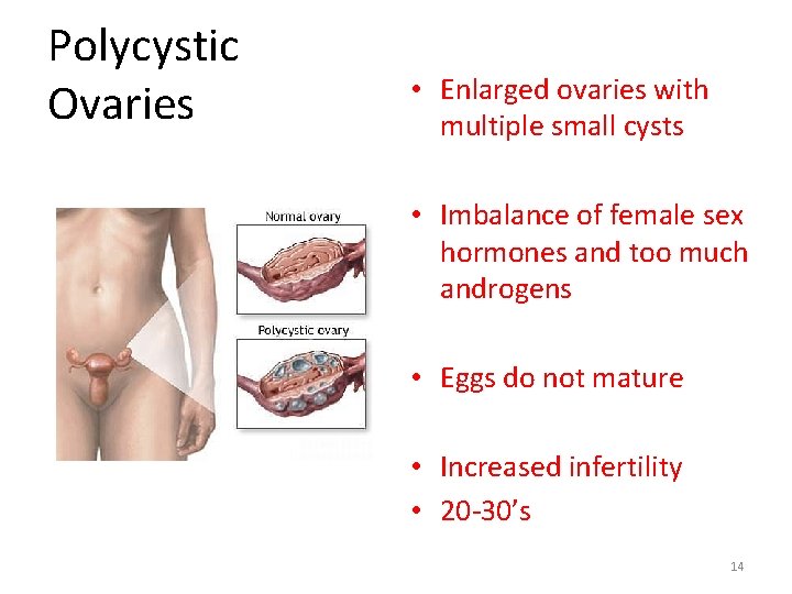 Polycystic Ovaries • Enlarged ovaries with multiple small cysts • Imbalance of female sex