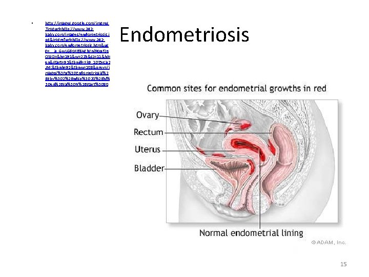  • http: //images. google. com/imgres ? imgurl=http: //www. 242 baby. com/images/endometriosis. j pg&imgrefurl=http: