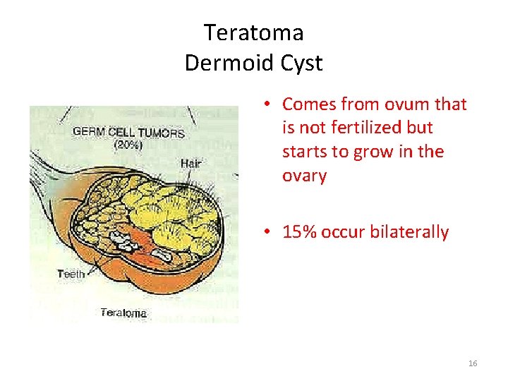 Teratoma Dermoid Cyst • Comes from ovum that is not fertilized but starts to