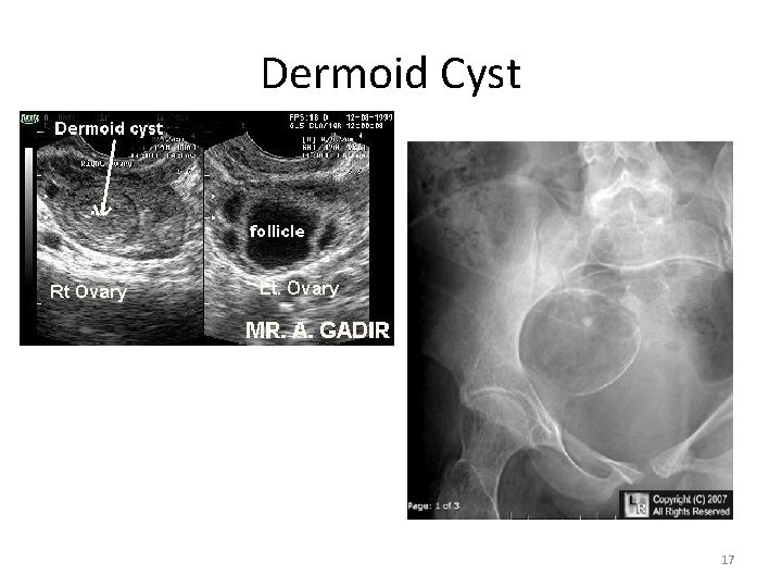 Dermoid Cyst 17 
