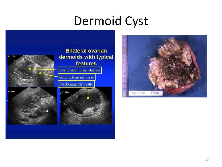 Dermoid Cyst 18 