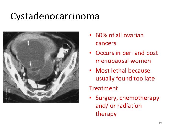 Cystadenocarcinoma • 60% of all ovarian cancers • Occurs in peri and post menopausal