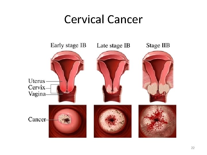 Cervical Cancer 22 