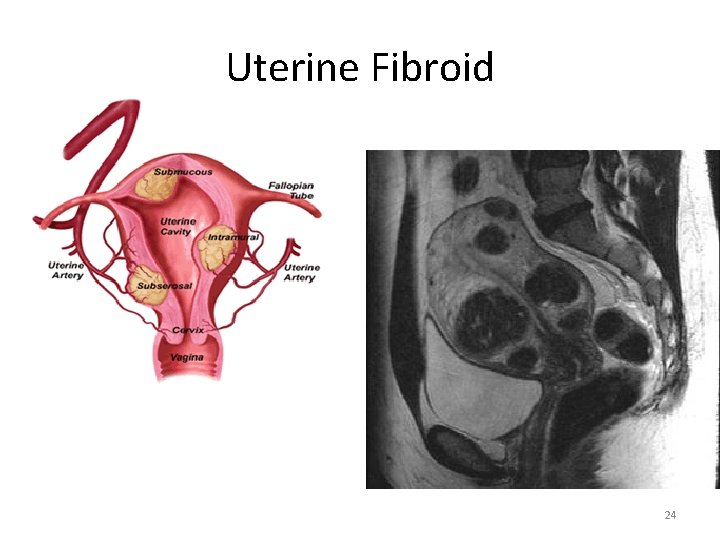 Uterine Fibroid 24 