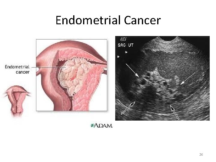 Endometrial Cancer 26 