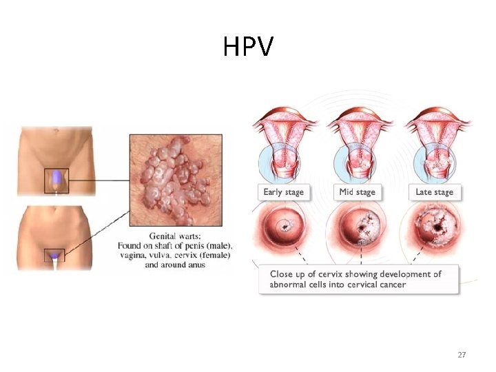 HPV 27 