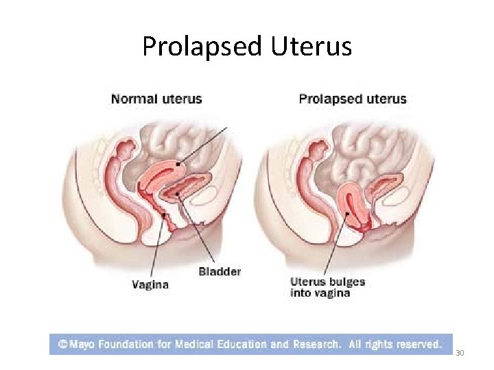 Prolapsed Uterus 30 