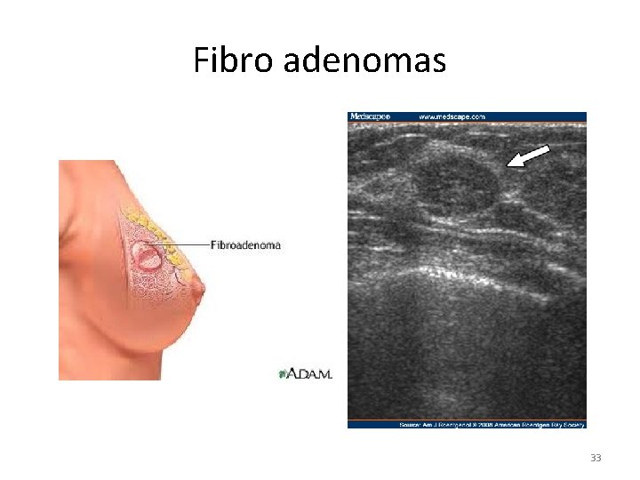 Fibro adenomas 33 