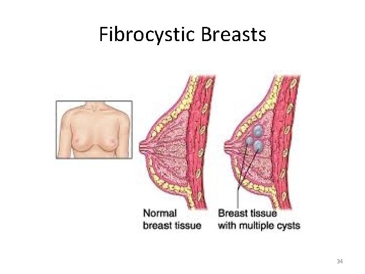 Fibrocystic Breasts 34 