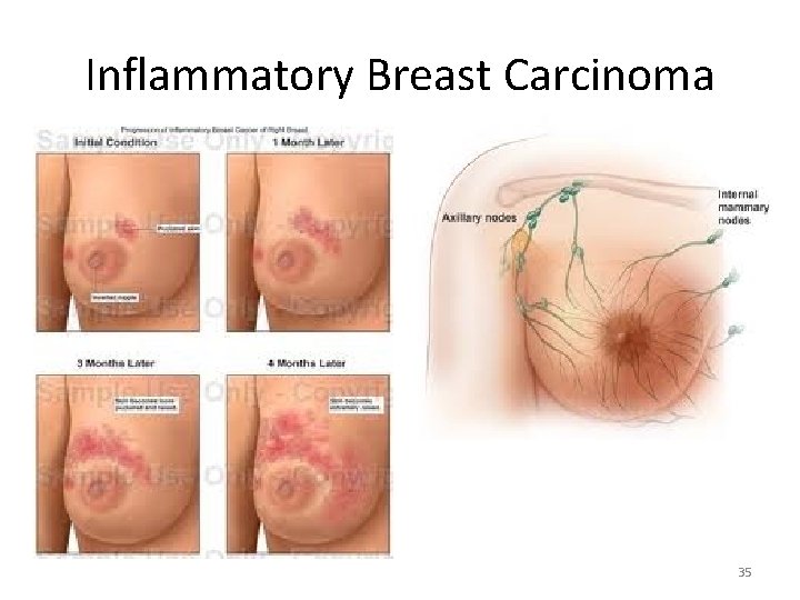 Inflammatory Breast Carcinoma 35 