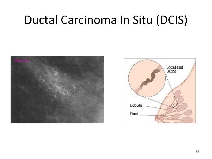 Ductal Carcinoma In Situ (DCIS) 36 