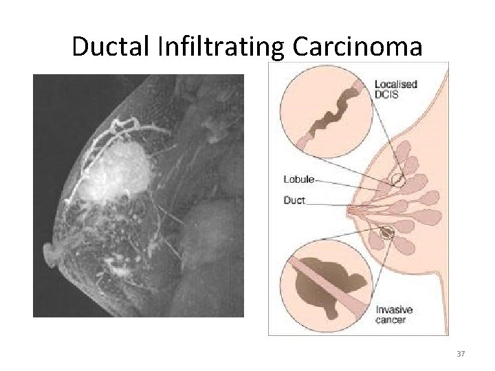 Ductal Infiltrating Carcinoma 37 