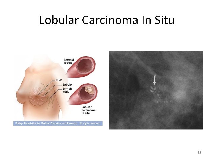 Lobular Carcinoma In Situ 38 