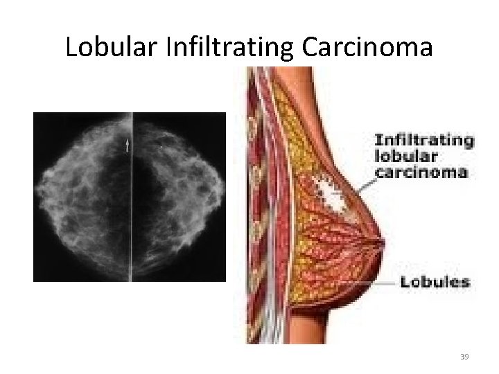 Lobular Infiltrating Carcinoma 39 