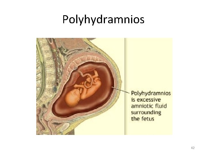 Polyhydramnios 42 