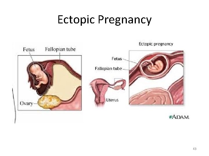 Ectopic Pregnancy 43 