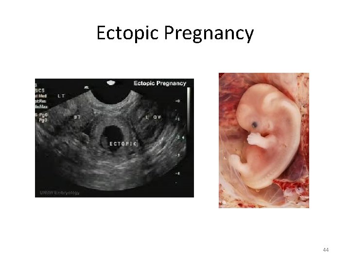 Ectopic Pregnancy 44 