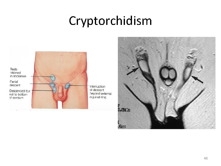 Cryptorchidism 48 