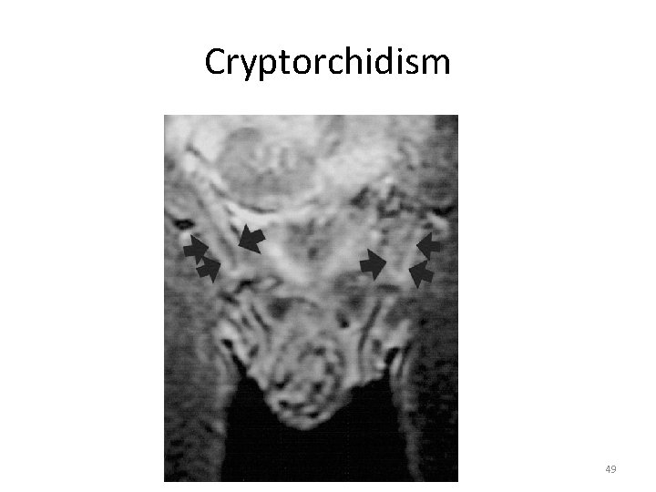 Cryptorchidism 49 