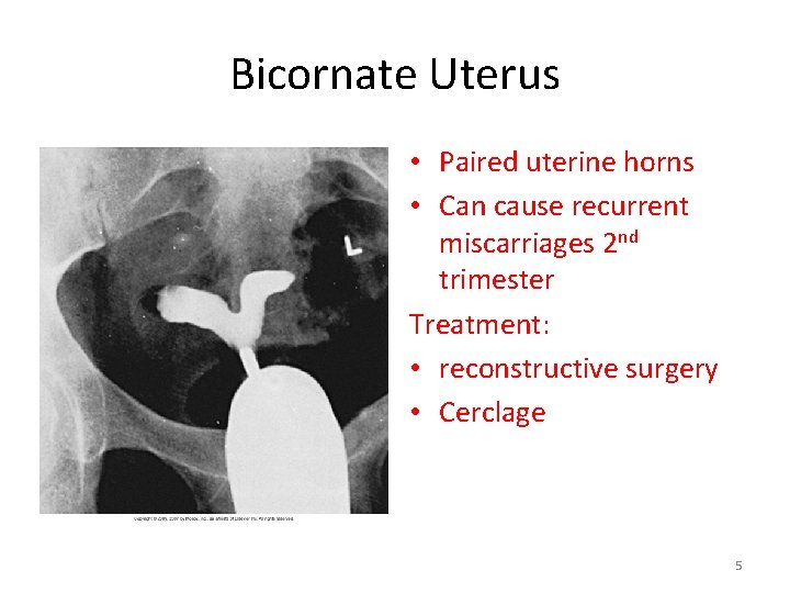 Bicornate Uterus • Paired uterine horns • Can cause recurrent miscarriages 2 nd trimester