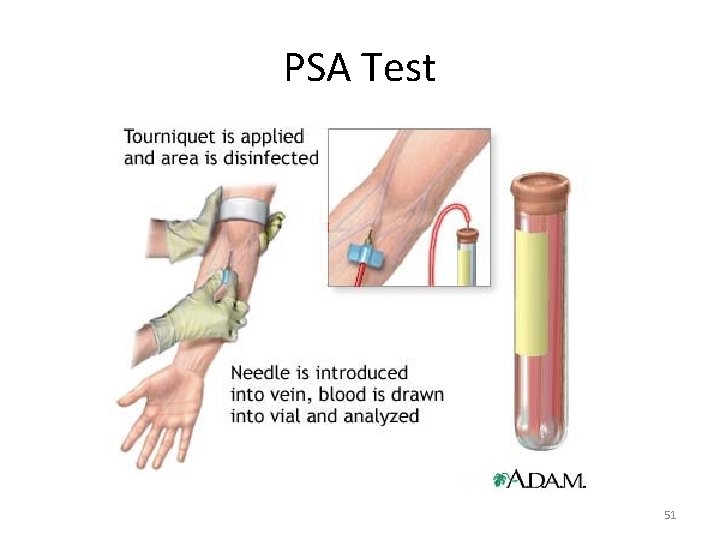 PSA Test 51 