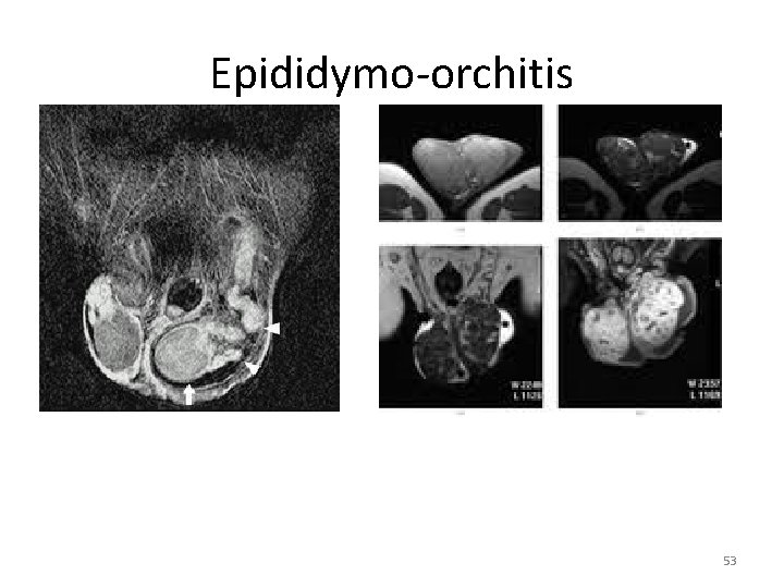 Epididymo-orchitis 53 