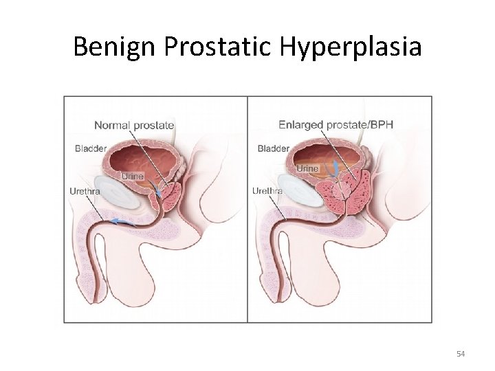Benign Prostatic Hyperplasia 54 