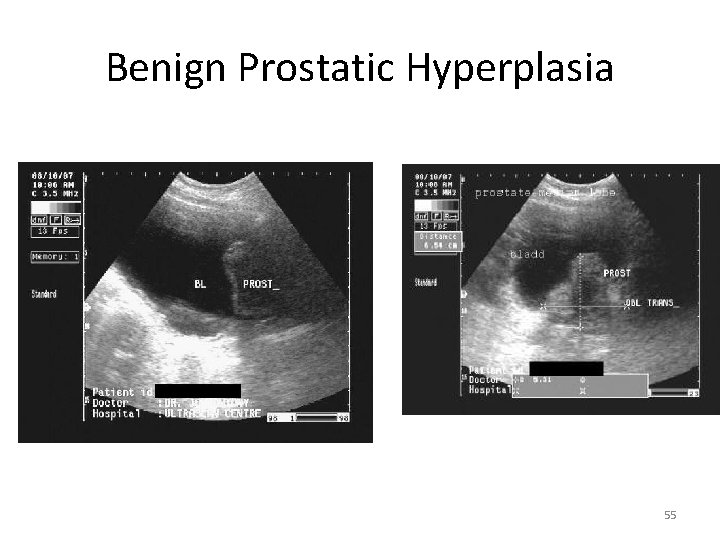 Benign Prostatic Hyperplasia 55 