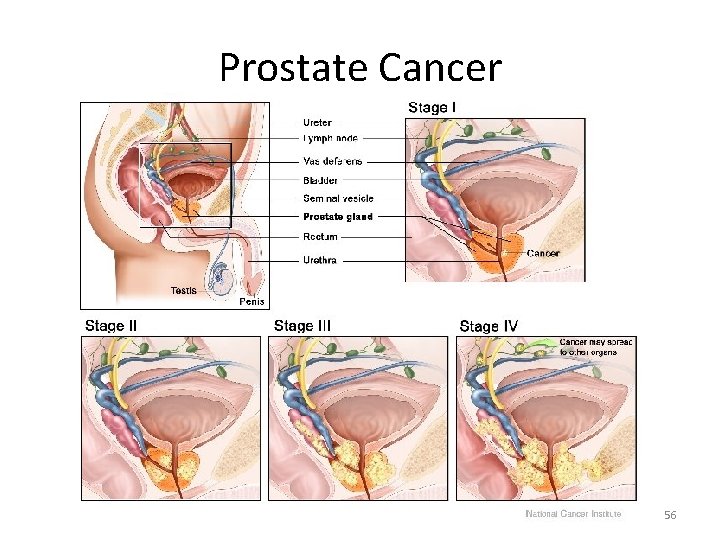 Prostate Cancer 56 