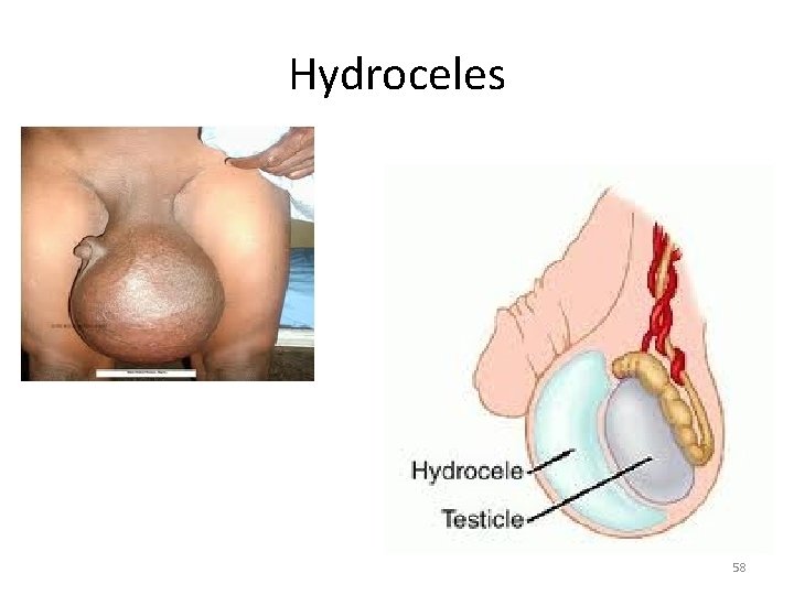 Hydroceles 58 