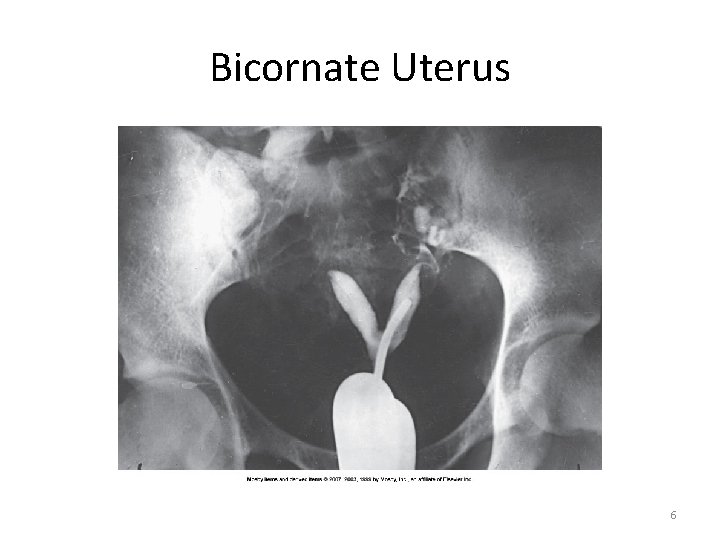 Bicornate Uterus 6 