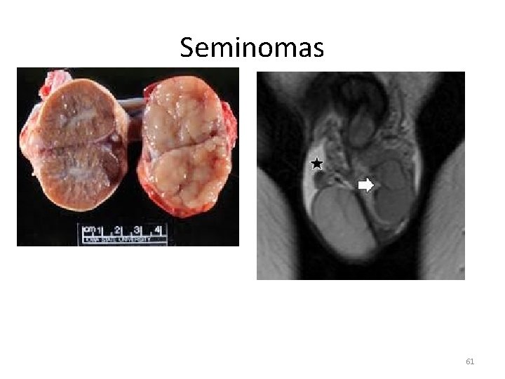 Seminomas 61 