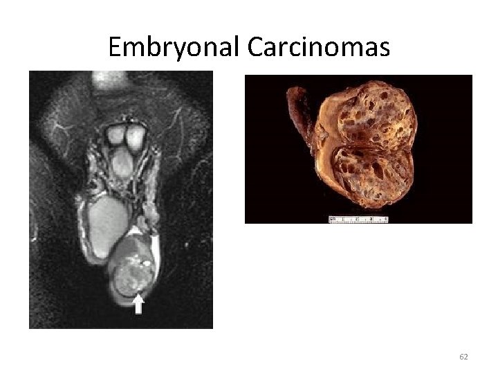 Embryonal Carcinomas 62 