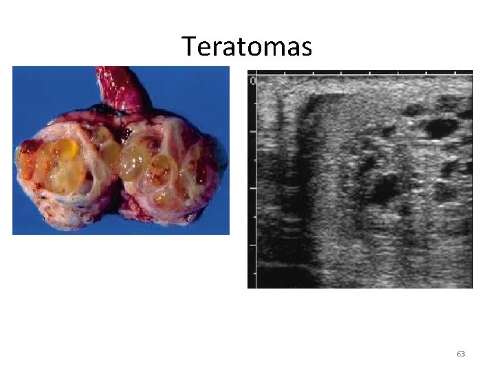 Teratomas 63 