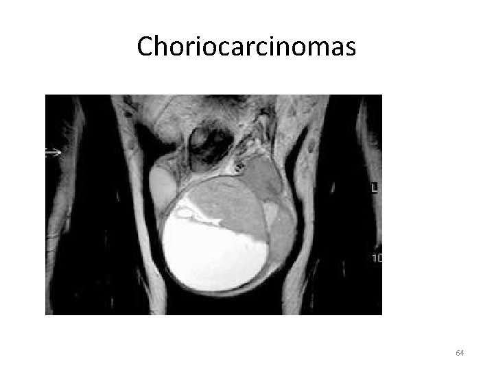 Choriocarcinomas 64 