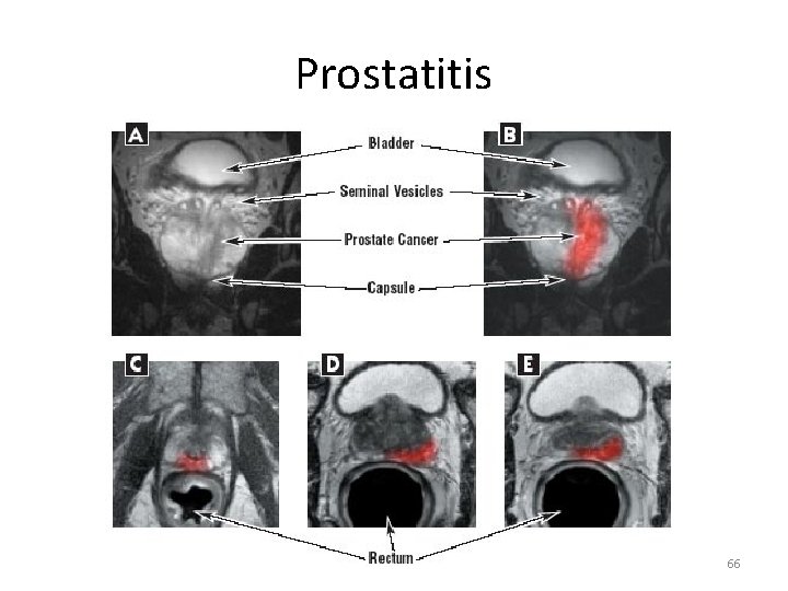 Prostatitis 66 