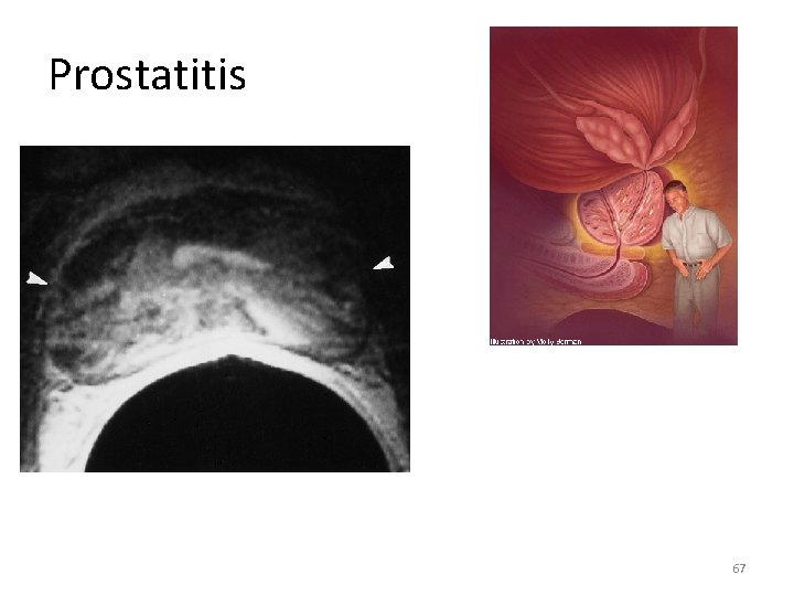 Prostatitis 67 