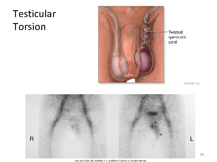 Testicular Torsion 68 