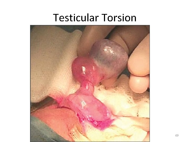 Testicular Torsion 69 