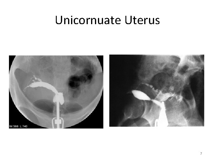 Unicornuate Uterus 7 