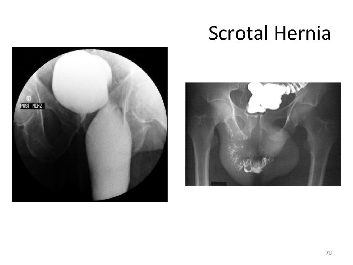 Scrotal Hernia 70 