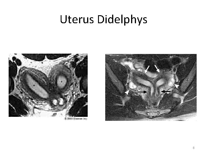 Uterus Didelphys 8 