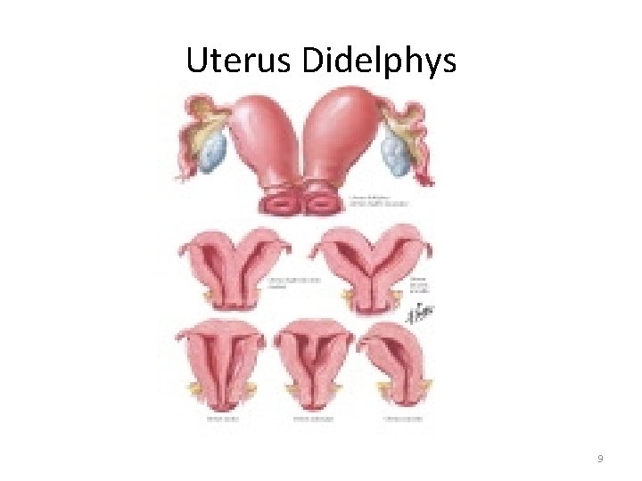 Uterus Didelphys 9 