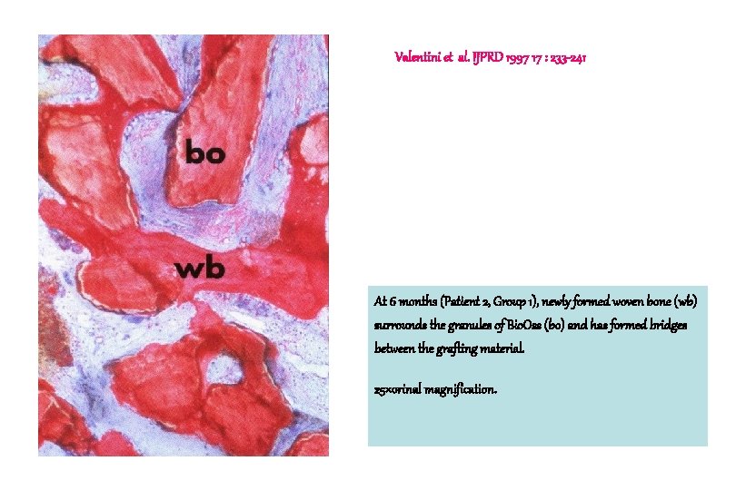 Valentini et al. IJPRD 1997 17 : 233 -241 At 6 months (Patient 2,